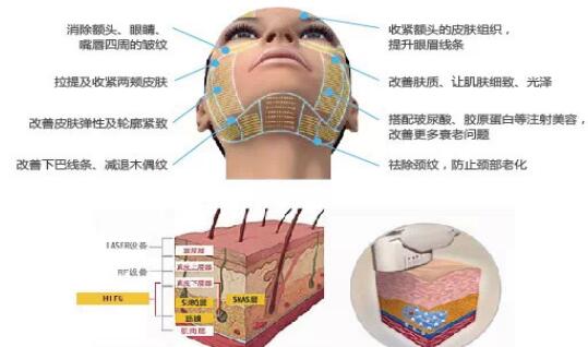 超声时光系统除皱